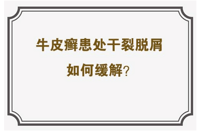 牛皮癣皮肤病怎么治疗